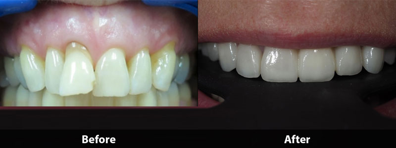 before & after difference of dental treatment