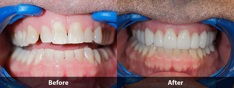 before & after difference of dental treatment