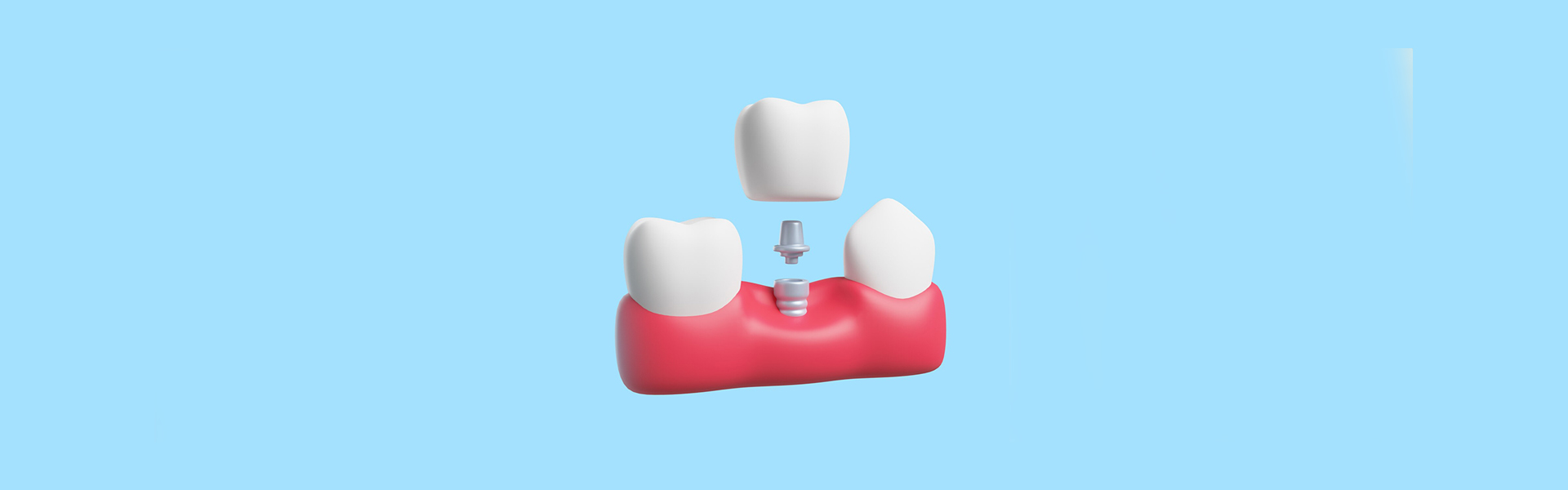 Benefits of Choosing Dental Implants at The Dental Co. of Leesburg
