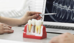 Maintaining Your Dental Implants: Tips for Long-Lasting Results