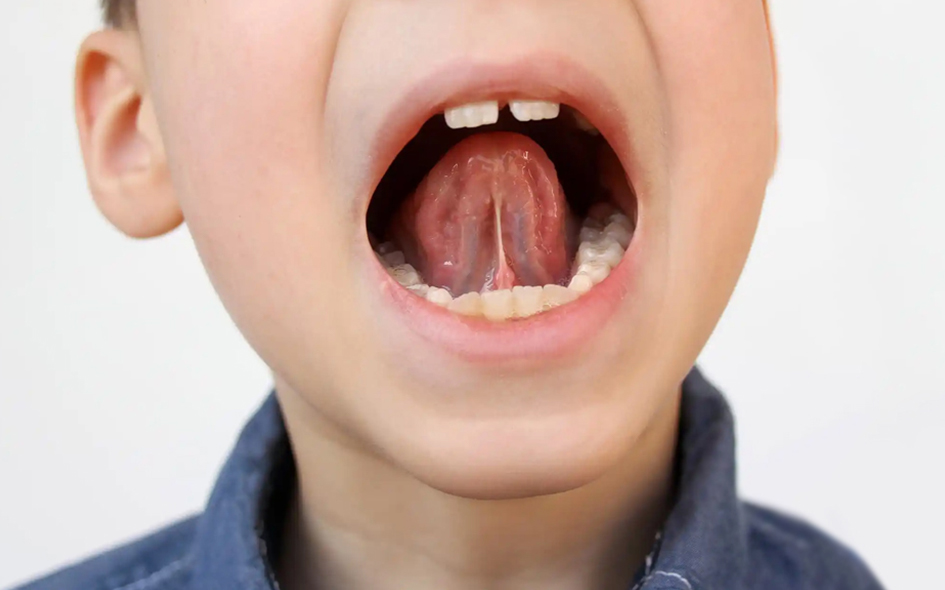 Tongue Tie Treatment at The Dental Co. Of Leesburg