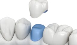 Dental Crowns in Leesburg, VA: Restore Your Smile with The Dental Co. of Leesburg